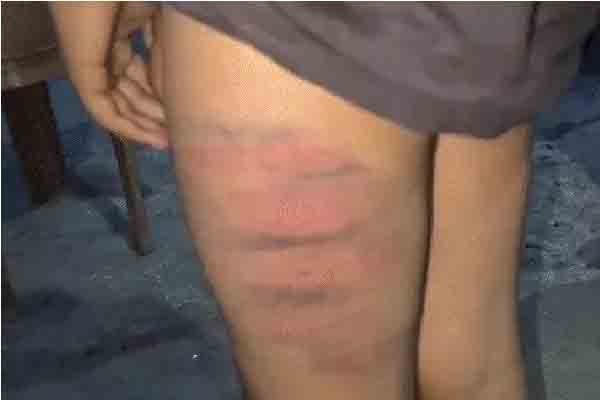Koderma: 7-year-old child brutally beaten up in Sai International School, FIR lodged against principal